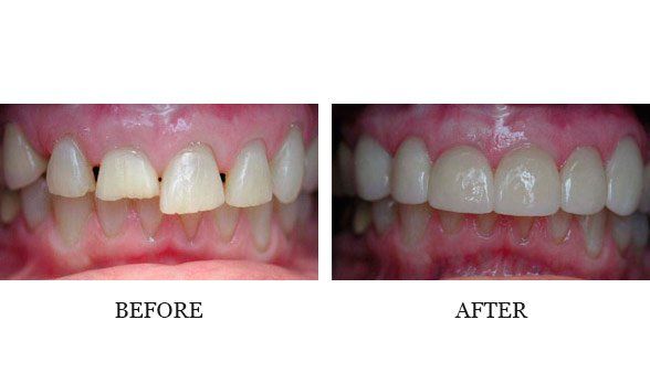 Ortho, whitening and ant crowns Dr. Mark