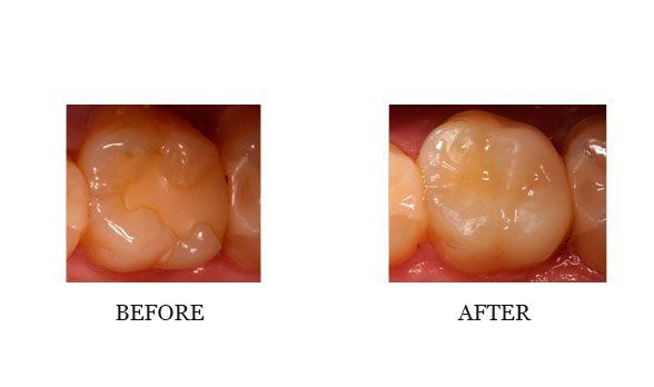 Cerec single visit crown/onlay Dr. Steve