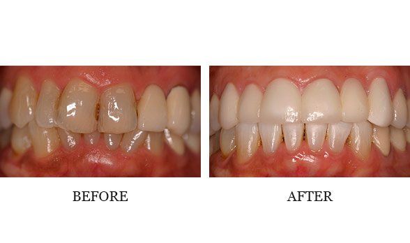 Whitening, Invisalign and ant crowns Combination case, Dr. Steve did Invisalign and Dr. Mark did whitening and crowns