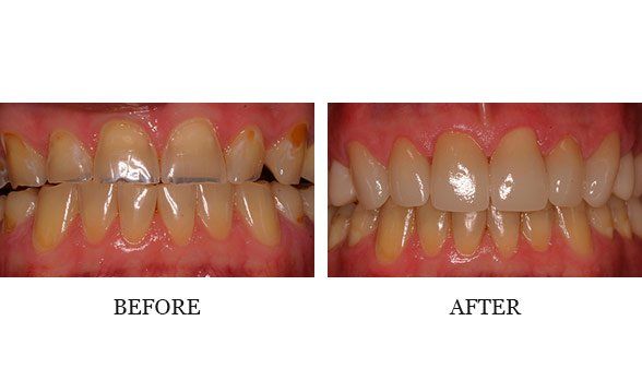 Upper ant CEREC crowns – Dr. Steve