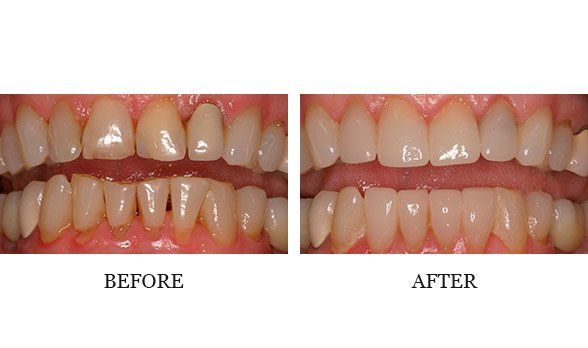 Full mouth veneers and CEREC crowns – Dr. Steve