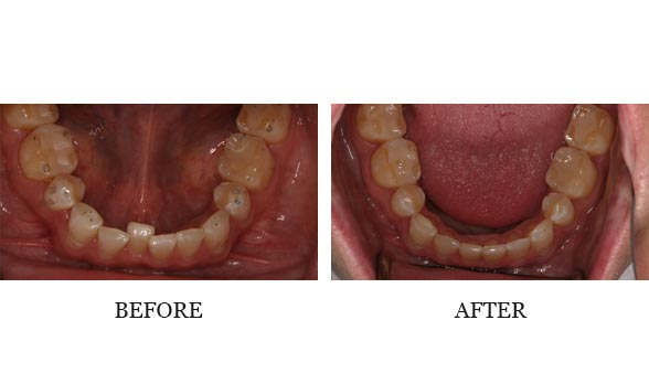 Invisalign - Mandibular Occlusal by Dr. Josh Walker