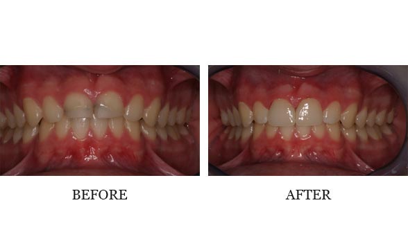 Veneers by Dr. Josh Walker