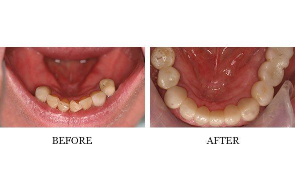 Implant restorations by Dr. Josh Walker