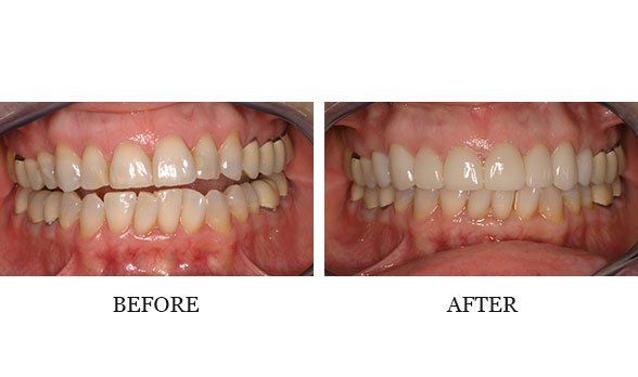 Upper anterior crowns by Dr. Mark Walker