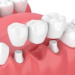 It is a 3d rendering of a dental bridge.