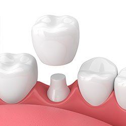 A 3d rendering of a dental crown being placed on a tooth.