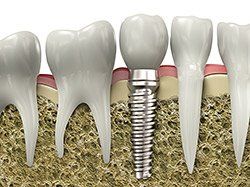 A dental implant is sitting in the middle of a row of teeth.