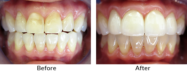 before and after teeth 3