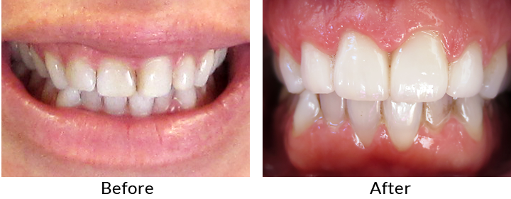 before and after teeth 1