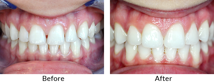before and after teeth 2