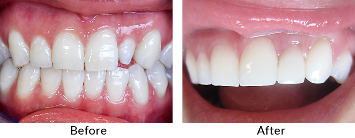 before and after teeth 4