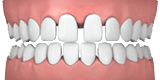 gaps in teeth