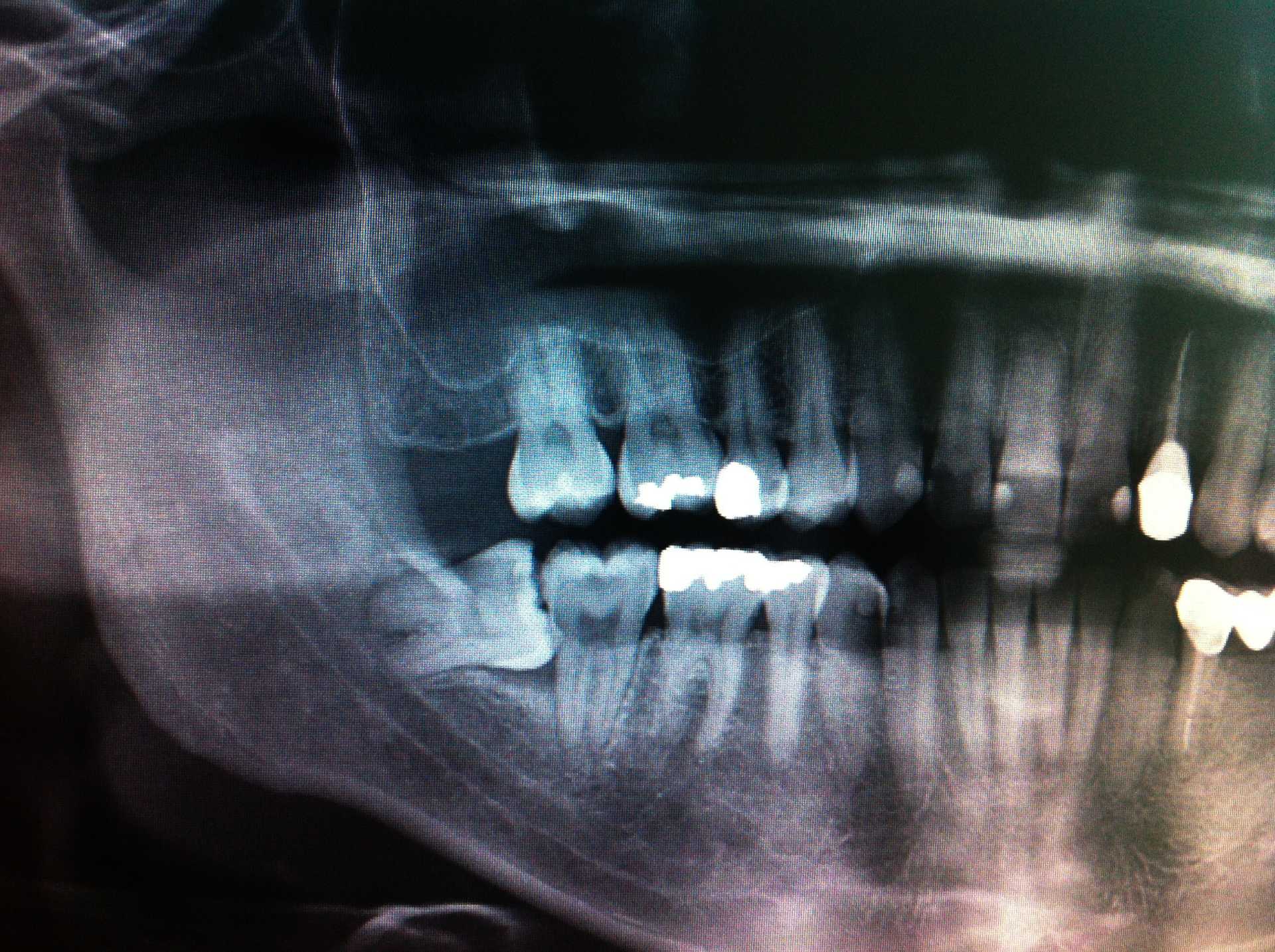Raggi ai denti