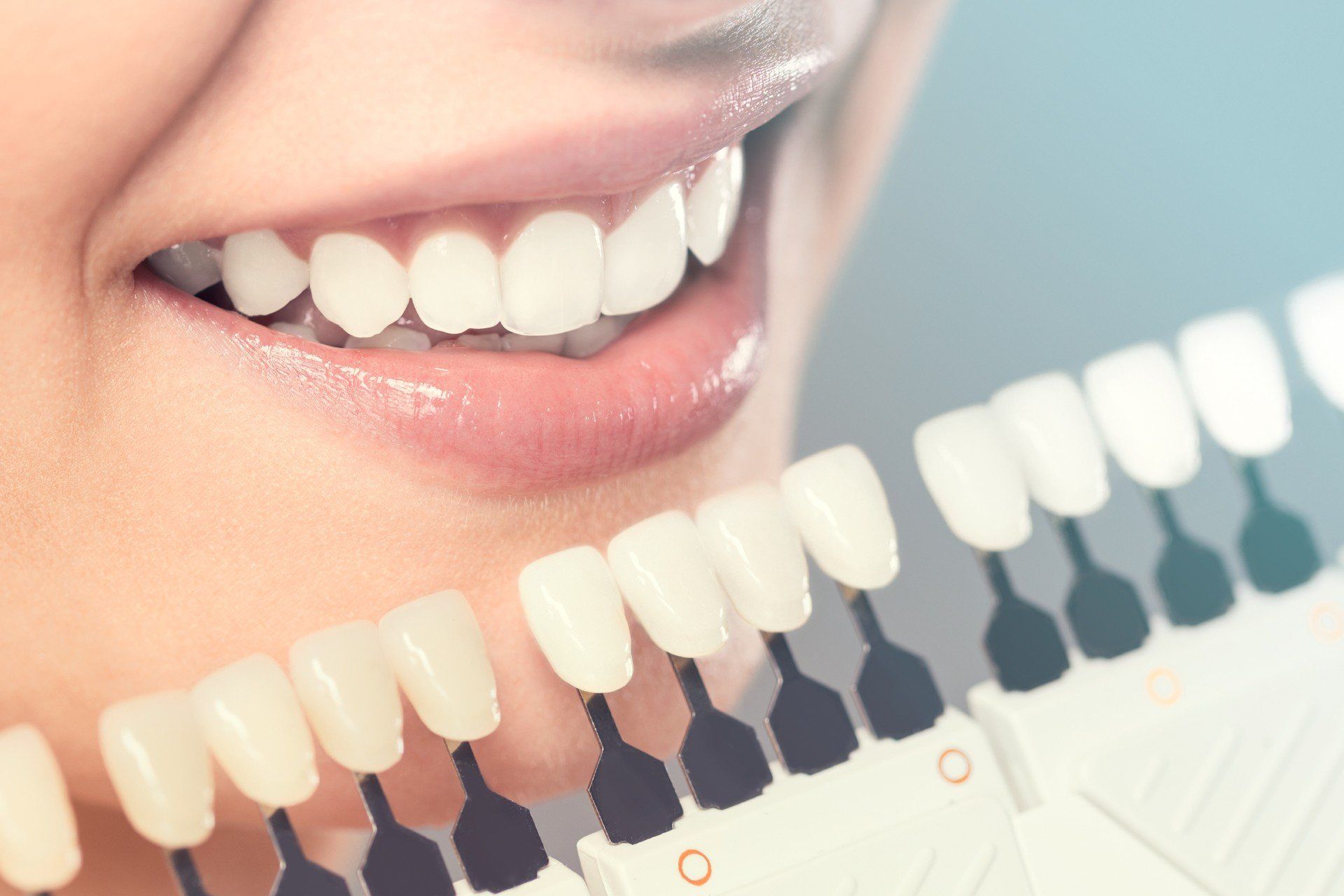 Sbiancamento dei denti
