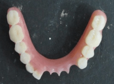Lower Acrylic Denture