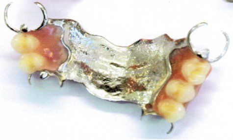 Part Upper Cast Metal Denture