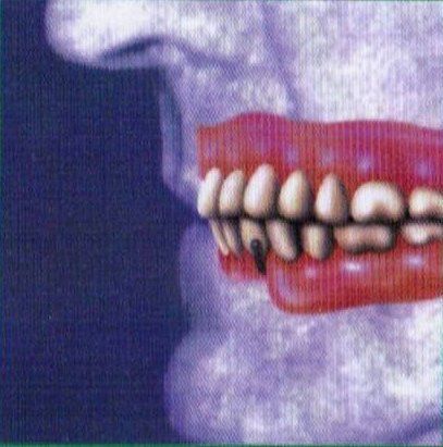 With Part Lower Denture Support