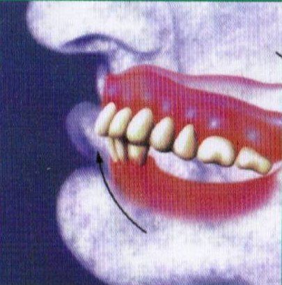 Without Part Lower Denture Support