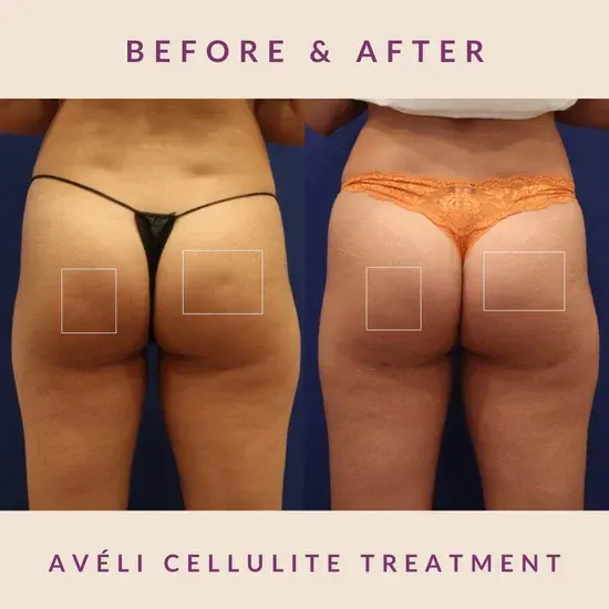 A before and after photo of a cellulite treatment