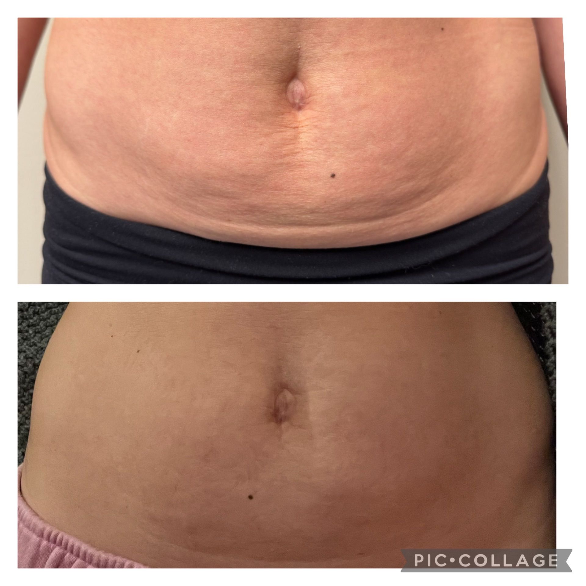 Density Abdomen