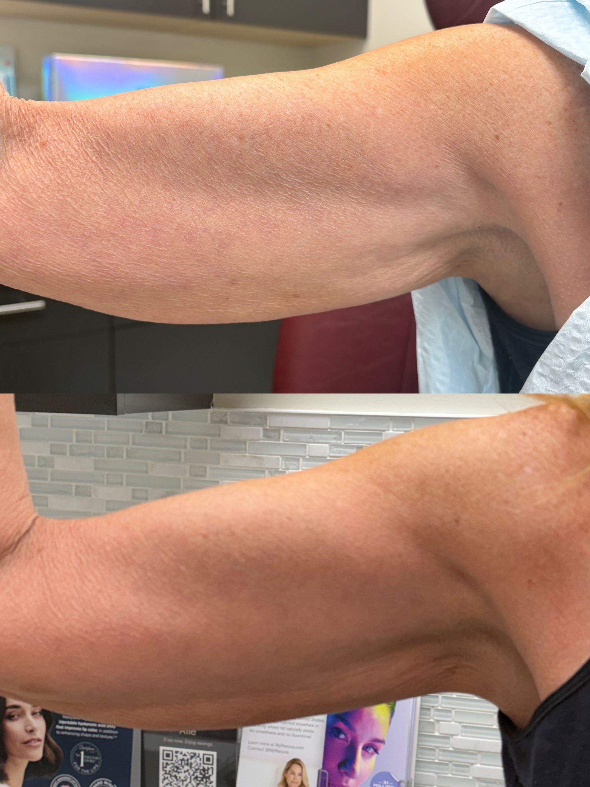 Density + AccuFit® Arms