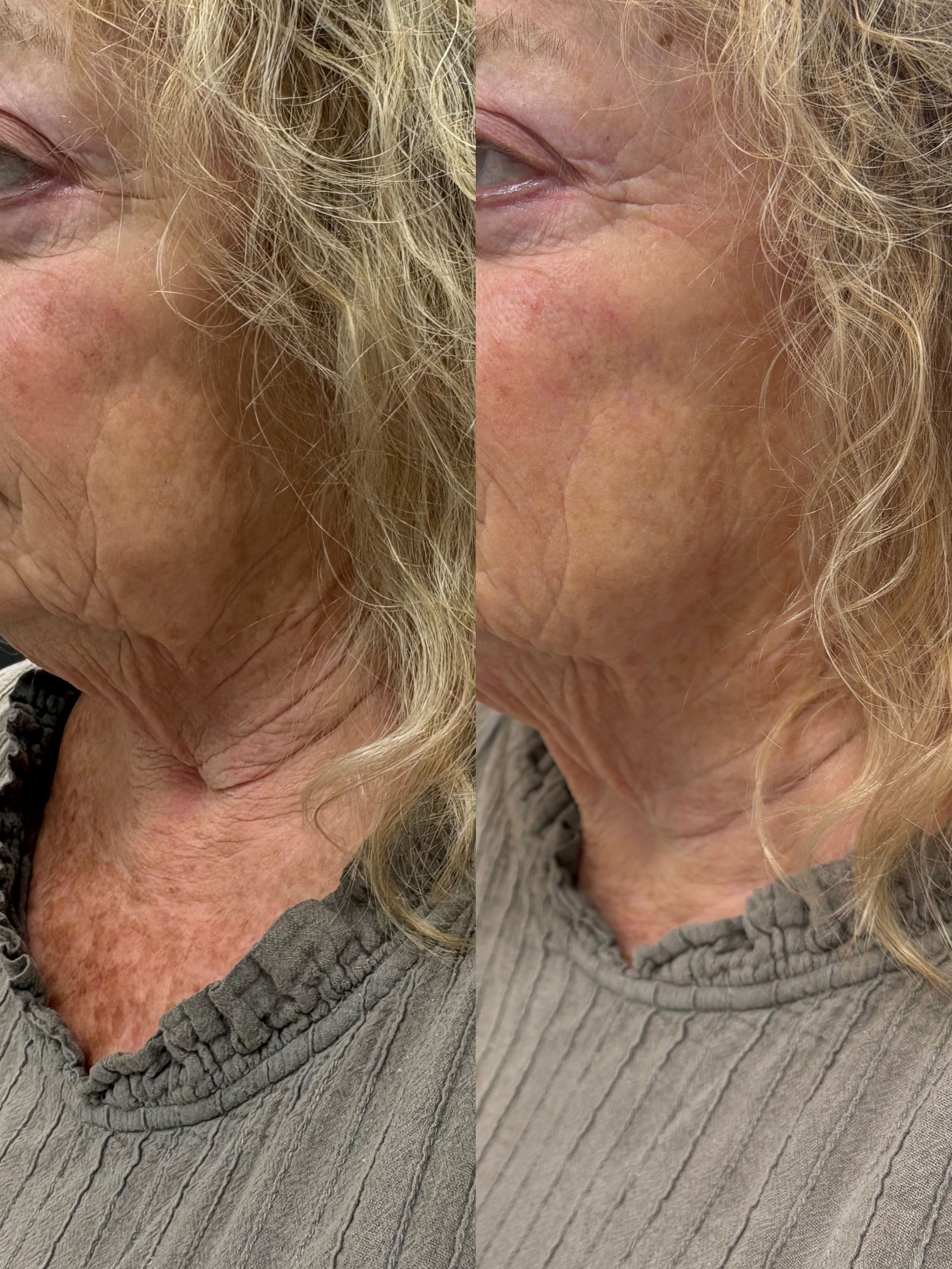 Density Neck and Jaw Line