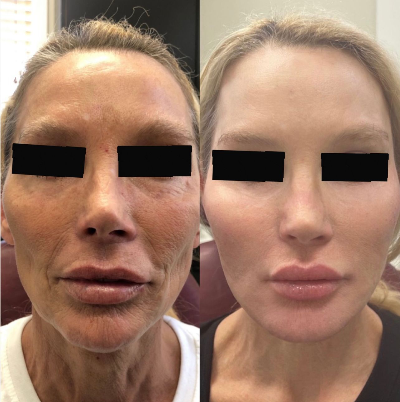 Real People, Real Results  BEFORE / AFTER      Multi-modality Non-Surgical Face and Neck Lift  By Dr. Ianculovici