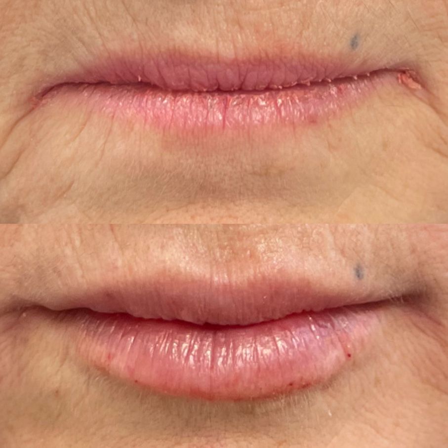 8D Lip Design by Dr. Corina Ianculovici  - Wall, NJ - Mirelle Anti Aging