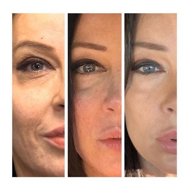 Laser Skin Resurfacing — Wall, NJ —Mirelle Anti Aging