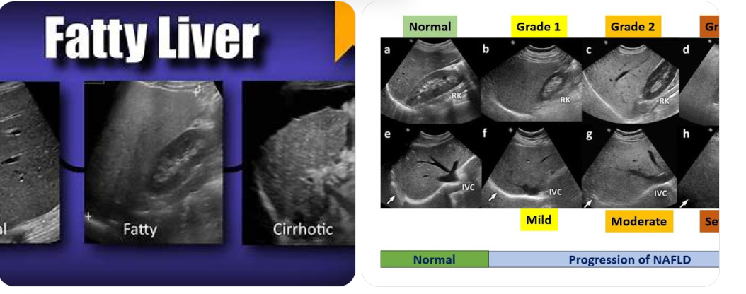 Fatty Liver disease