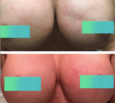 Vampire Breast Lift After Surgica- Wall, NJ - Mirelle Anti Aging