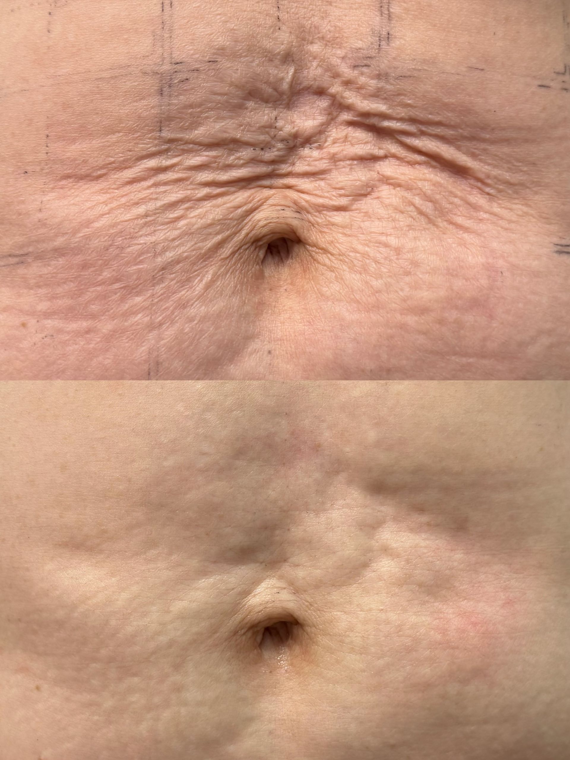 Density Abdomen