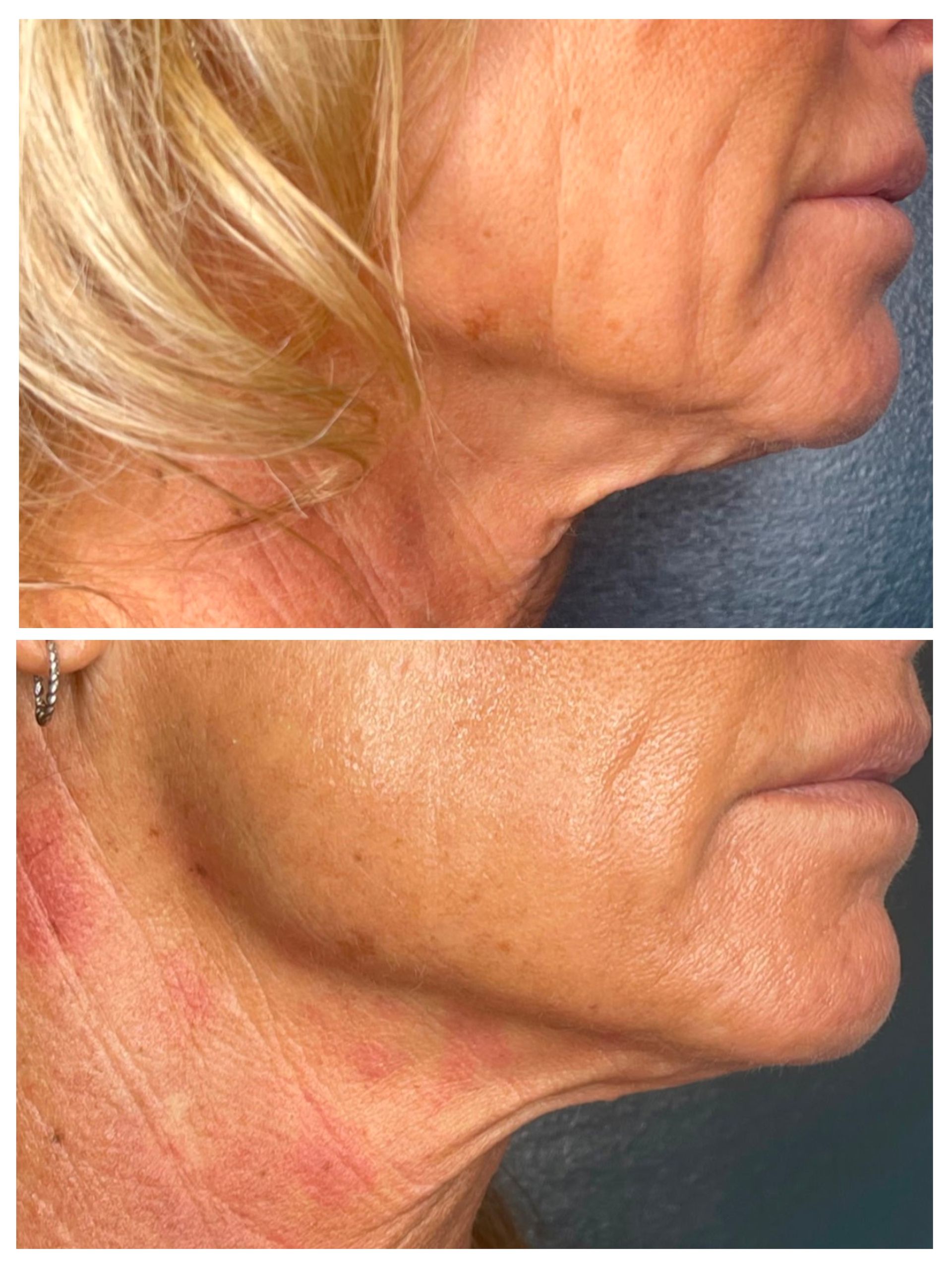 Density Mid-Face and Neck