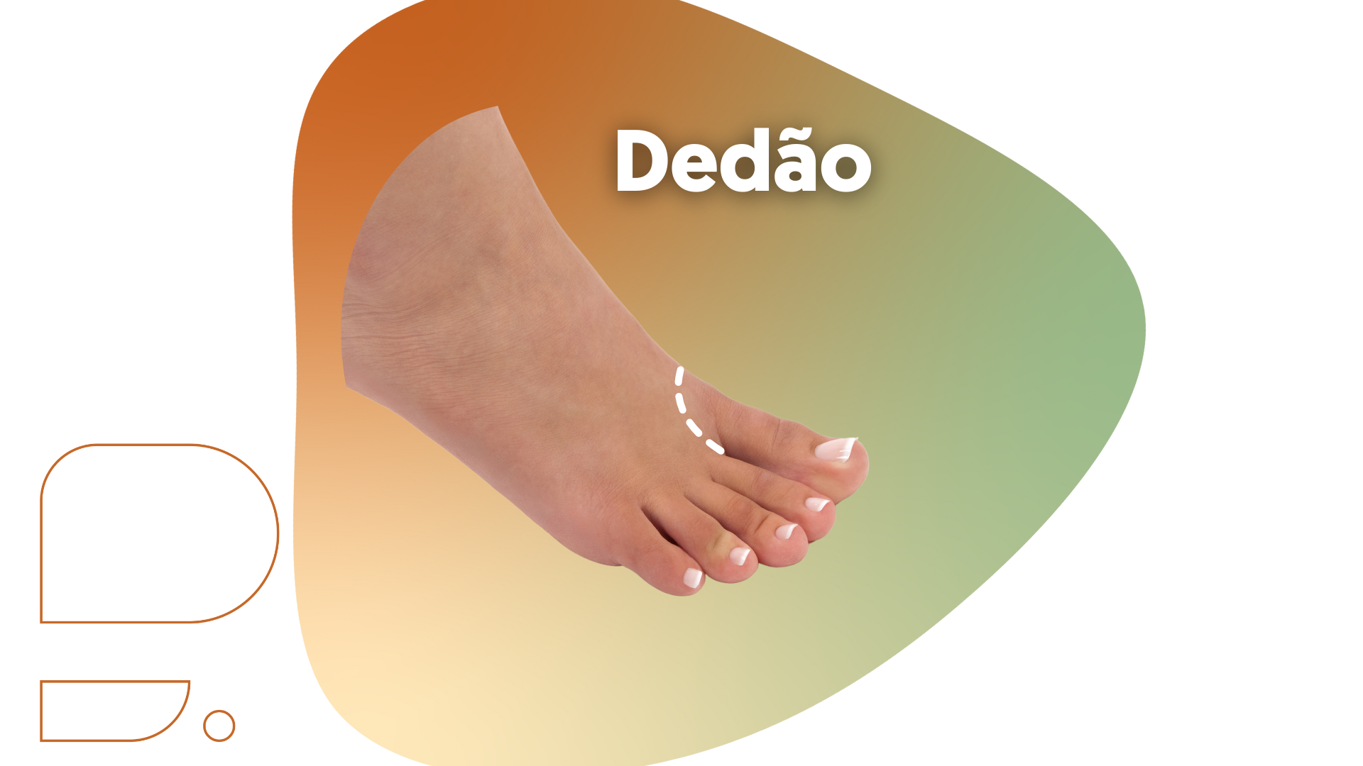 Superação Após Amputação do Dedão do Pé: Recuperação e Adaptação