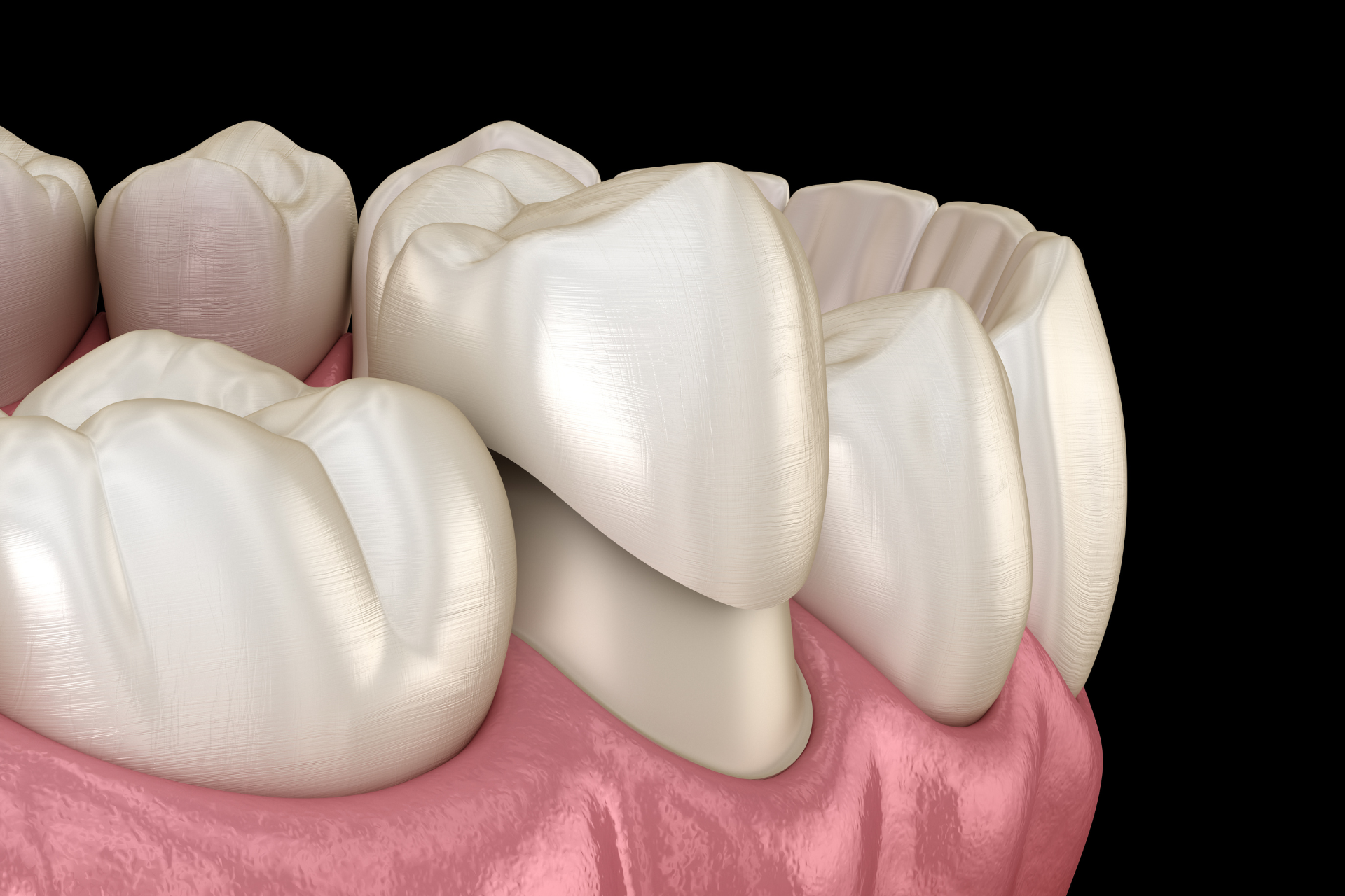 Image of sample for Dental Crowns