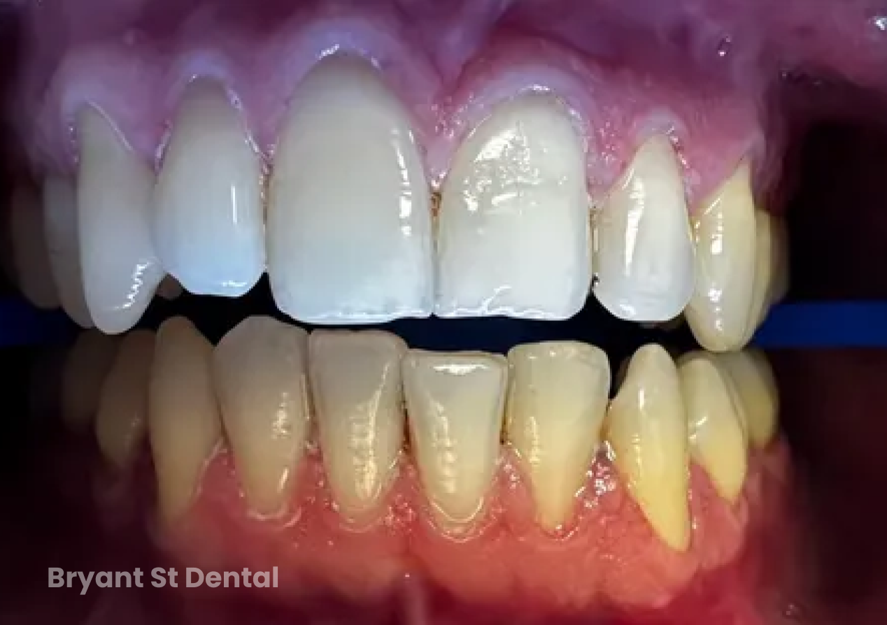 a close up of a person 's teeth with white teeth .