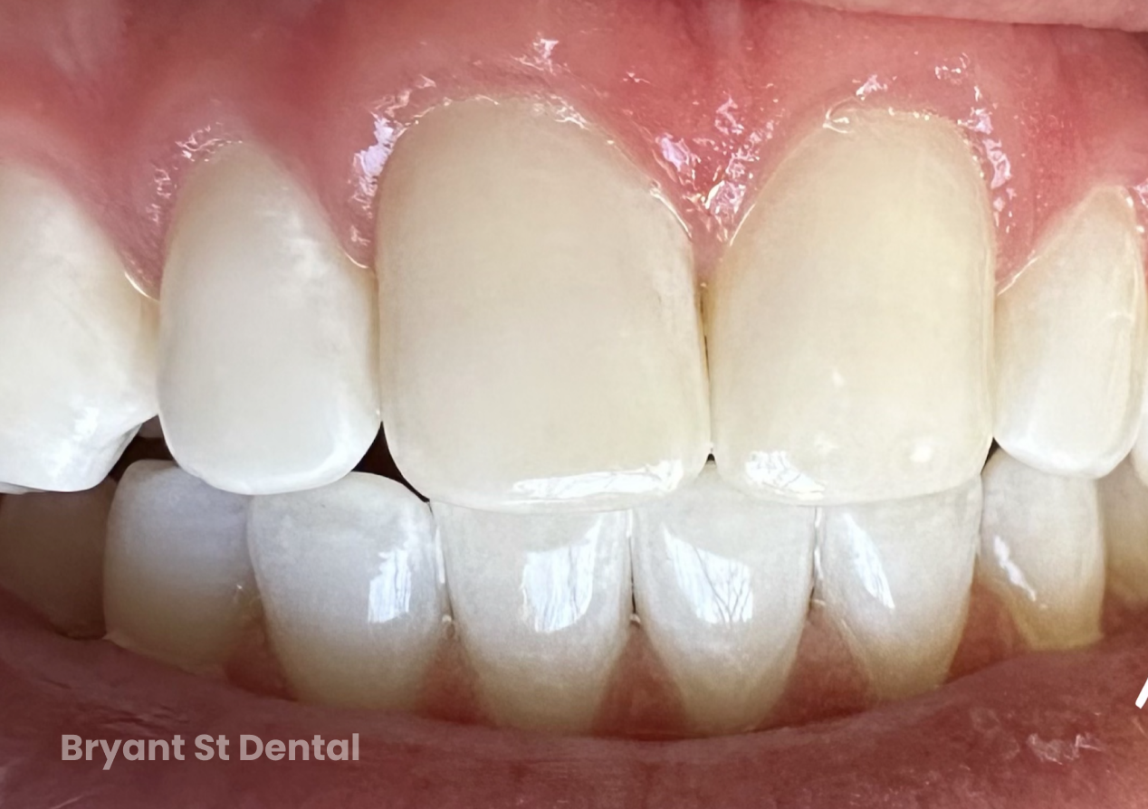 Best Dentist in Palo Alto Dentistry Bryant St Dental