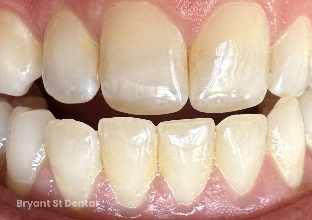 a close up of a person 's teeth with the words bryant st dental written on the bottom .