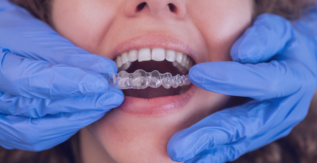 Unlock Your Best Smile: With Invisalign for Misaligned Teeth