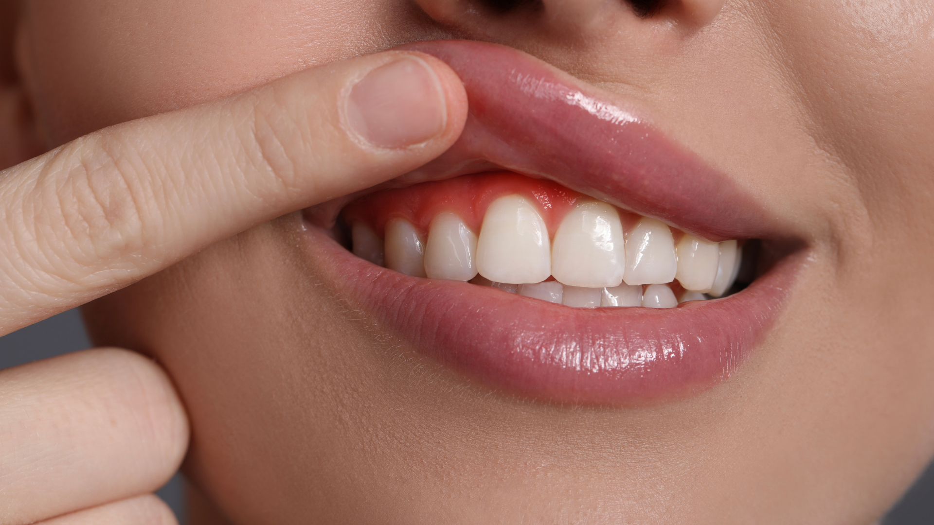 A close-up of a person lifting their upper lip to reveal red, inflamed gums around the upper teeth.