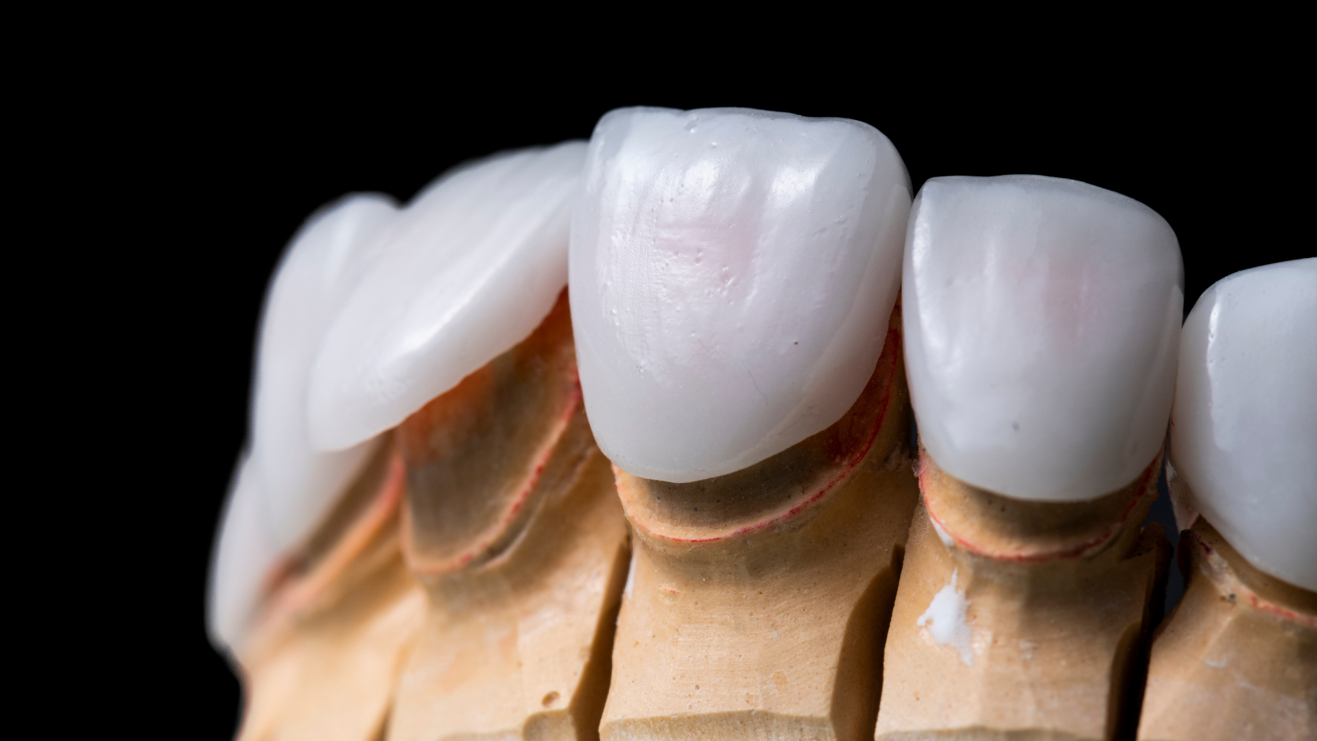 Close-up of ceramic veneers on a model, showcasing white teeth and pink gumline against a black background.