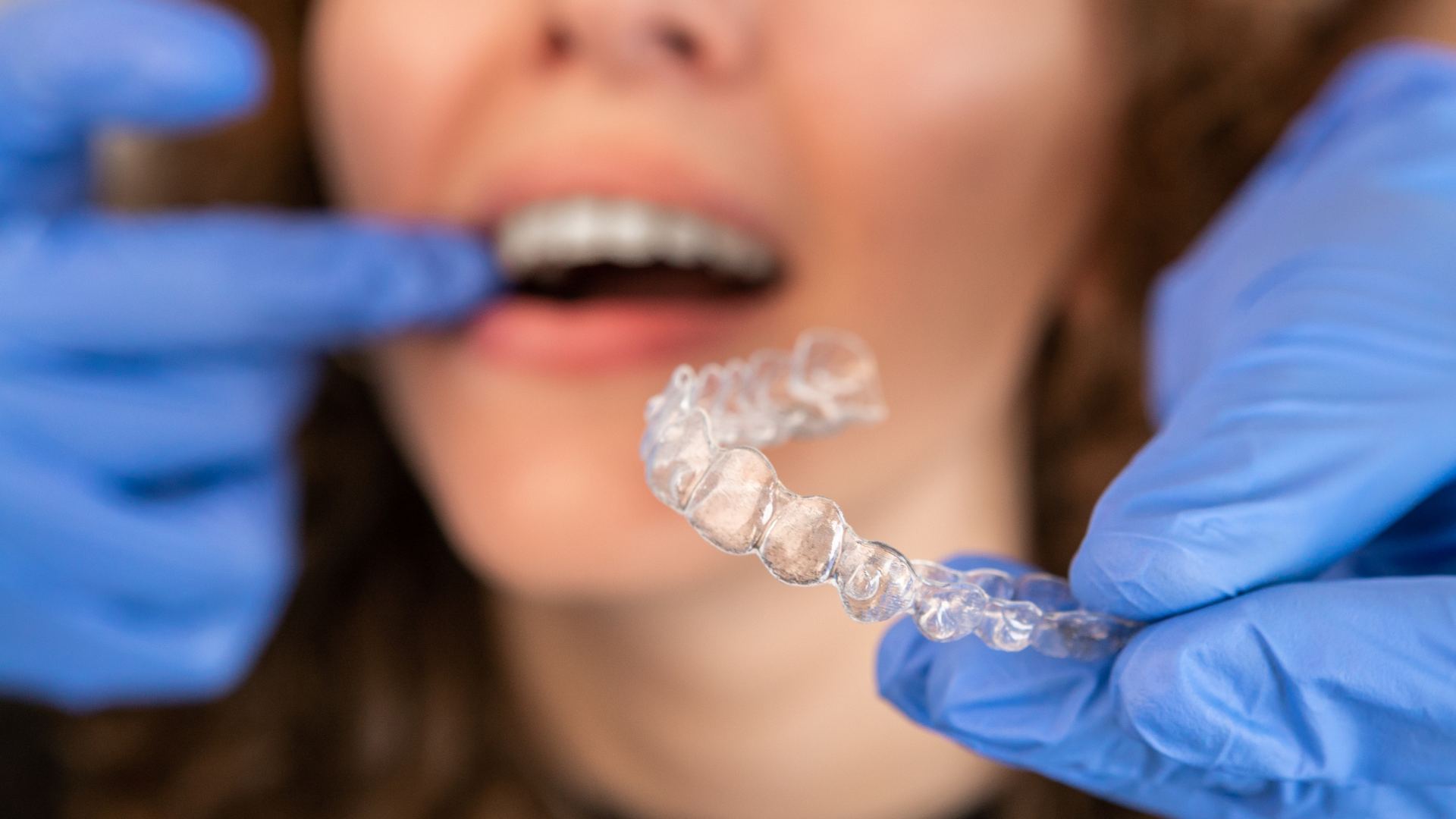 Person wearing blue gloves holds clear aligner near open mouth, ready for placement.