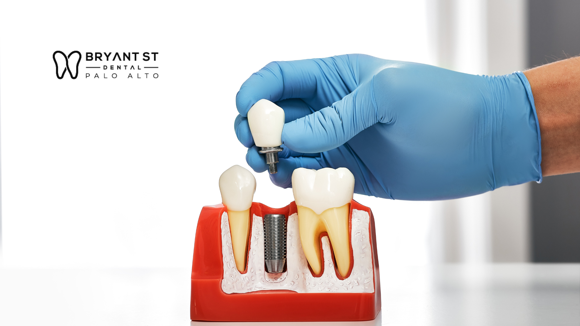 A dentist is putting a dental implant into a model of teeth.