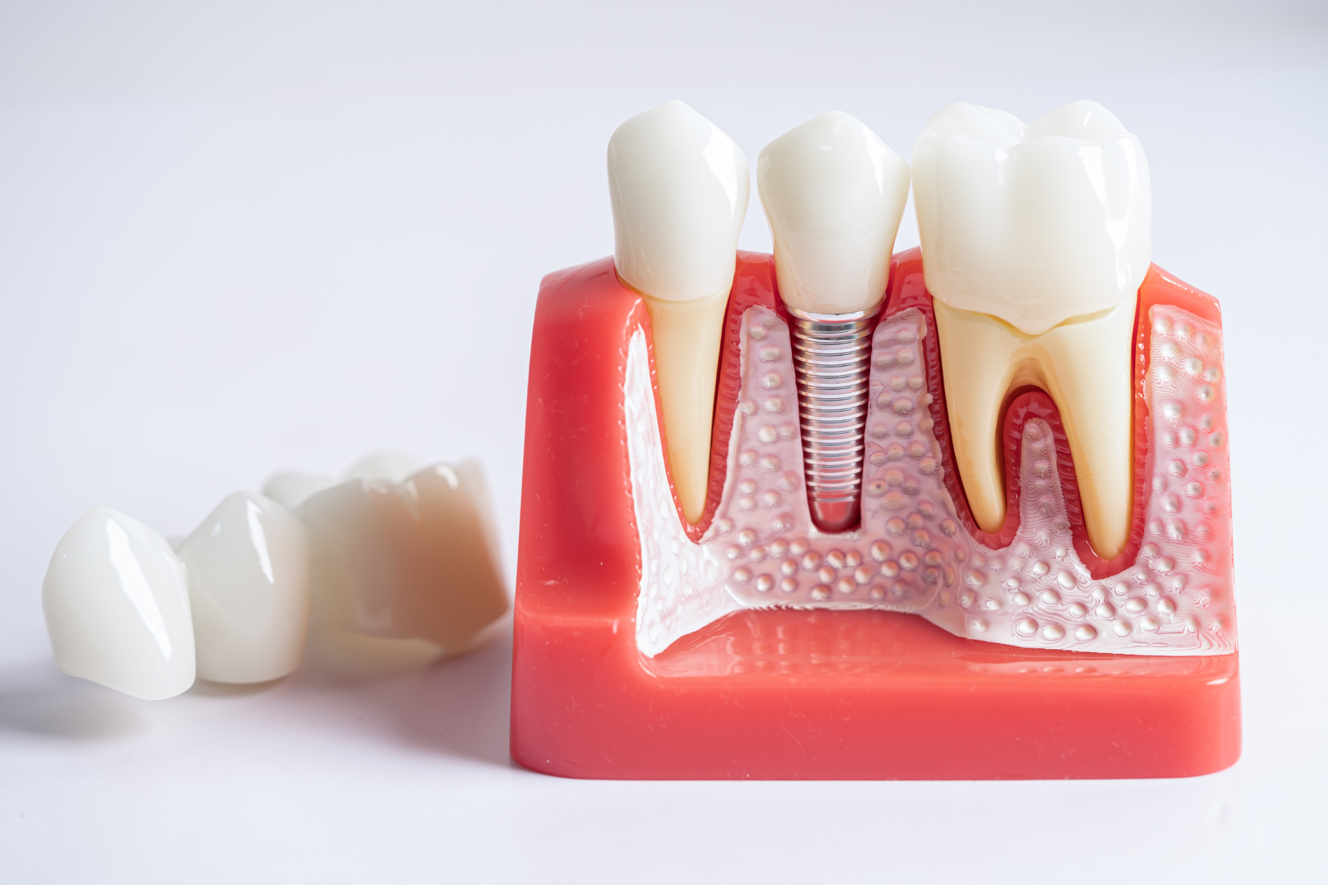 Image of sample for dental implants