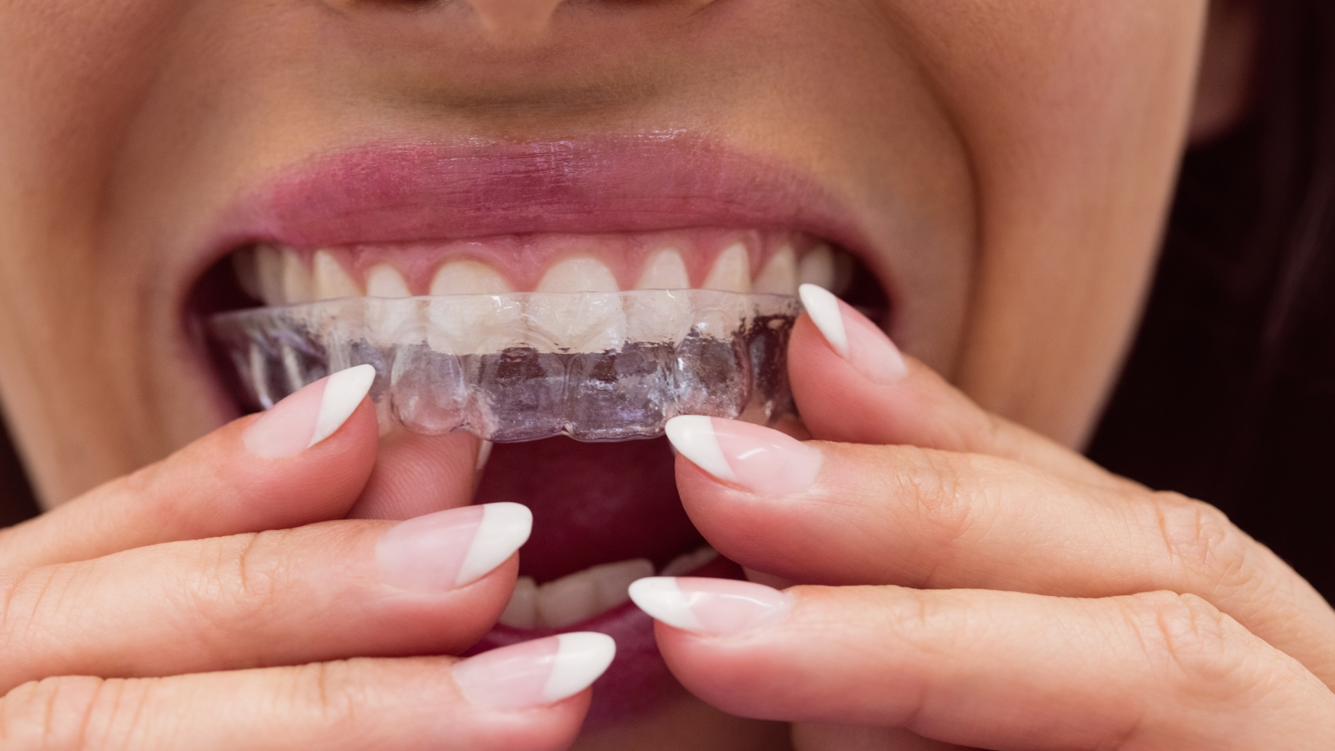 A woman is holding a clear brace in her mouth.
