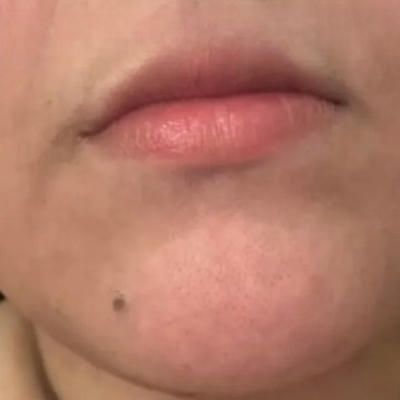 An after image close up of a man's face with clear skin and no hair after laser hair removal.