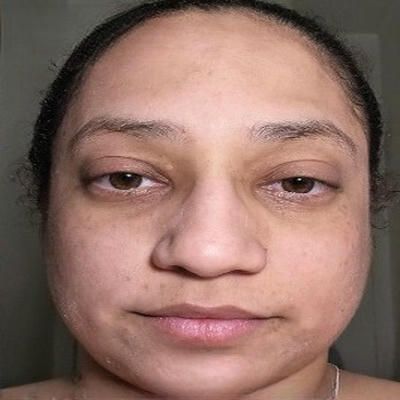 A close up of a woman 's face after microneedling treatment.