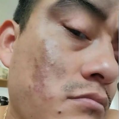 A before image close up of a man 's face with a skin darkness.