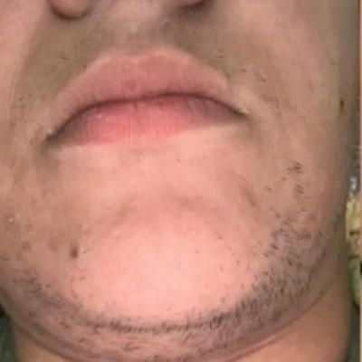 A before image close up of a man 's face with patchy hair on chin.